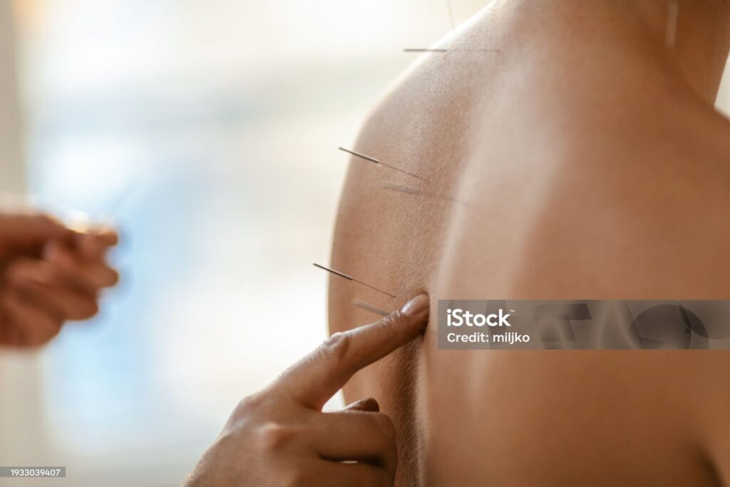 Agopuntura-da-Pixabay.1webp-1-1024x683 FIBROMIALGIA. PERCHE’ TRATTARLA CON L’AGOPUNTURA?